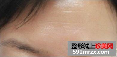 美女带妈妈一起体验玻尿酸除皱术