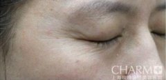 美女带妈妈一起体验玻尿酸除皱术
