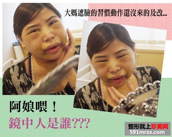 女子自曝削骨手术的过程 从大妈变成女神
