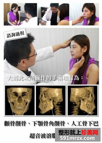 女子自曝削骨手术的过程 从大妈变成女神