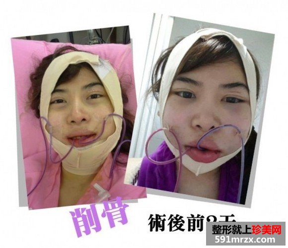 女子自曝削骨手术的过程 从大妈变成女神