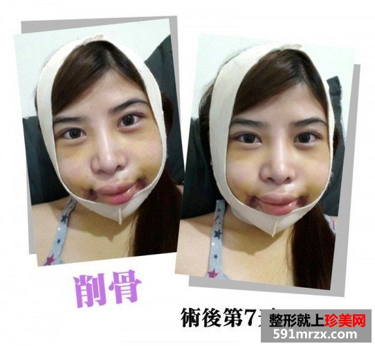 女子自曝削骨手术的过程 从大妈变成女神
