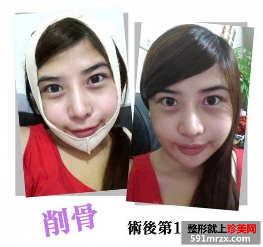 女子自曝削骨手术的过程 从大妈变成女神