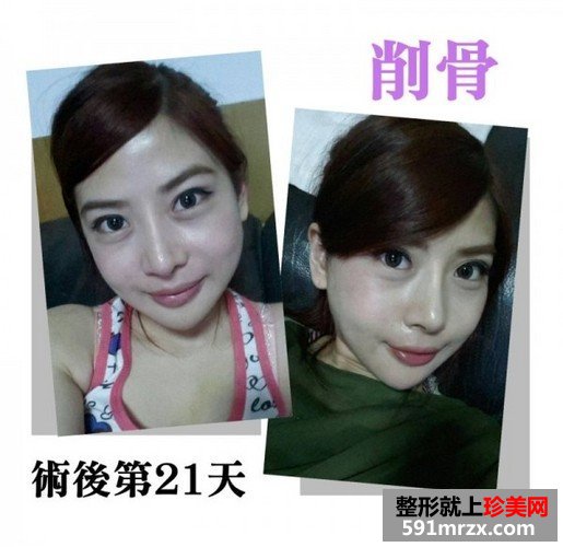 女子自曝削骨手术的过程 从大妈变成女神