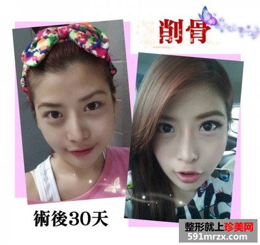 女子自曝削骨手术的过程 从大妈变成女神