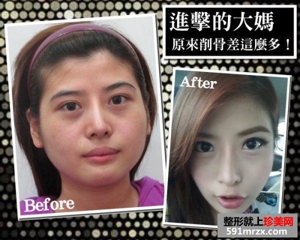 女子自曝削骨手术的过程 从大妈变成女神