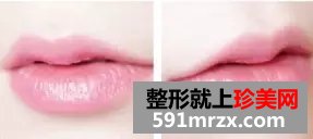 做了玻尿酸注射丰唇珠后，没涂唇彩也美丽