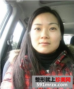 做了玻尿酸注射丰唇珠后，没涂唇彩也美丽
