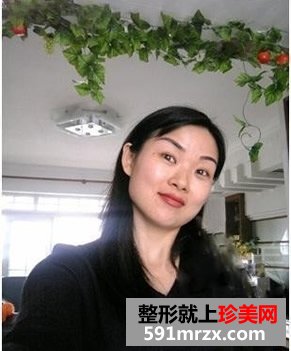 做了玻尿酸注射丰唇珠后，没涂唇彩也美丽