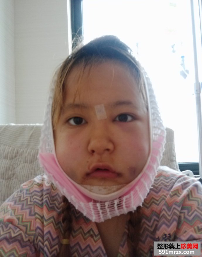 下巴整形经历 双颚手术后的惊人变化