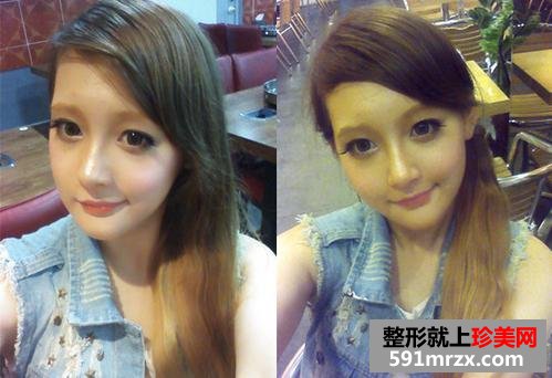 下巴整形经历 双颚手术后的惊人变化