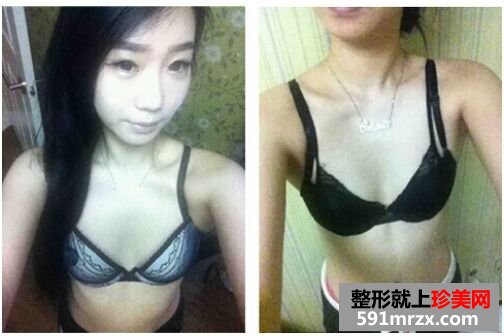 韩国隆胸手术做的效果好不好?看了就知道