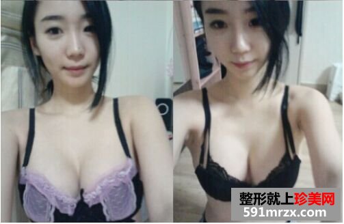 韩国隆胸手术做的效果好不好?看了就知道
