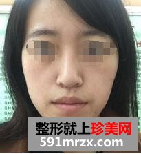 自体脂肪面部填充，年轻才是真的美~~~