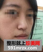 自体脂肪面部填充，年轻才是真的美~~~
