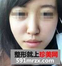 自体脂肪面部填充，年轻才是真的美~~~