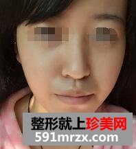 自体脂肪面部填充，年轻才是真的美~~~