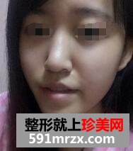 自体脂肪面部填充，年轻才是真的美~~~