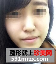 自体脂肪面部填充，年轻才是真的美~~~