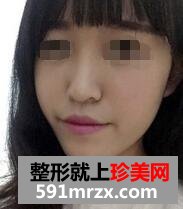 自体脂肪面部填充，年轻才是真的美~~~