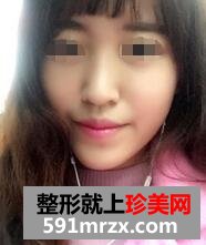 自体脂肪面部填充，年轻才是真的美~~~