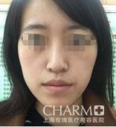 自体脂肪面部填充，年轻才是真的美~~~
