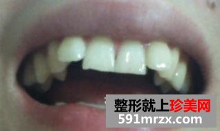 趁着还年轻，我决定去做侍美牙齿矫正