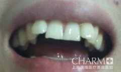趁着还年轻，我决定去做侍美牙齿矫正