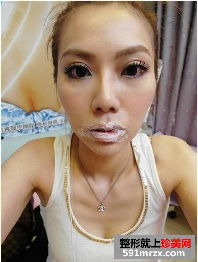 玻尿酸注射丰唇珠手术，让我安吉丽娜朱莉的性感丰唇