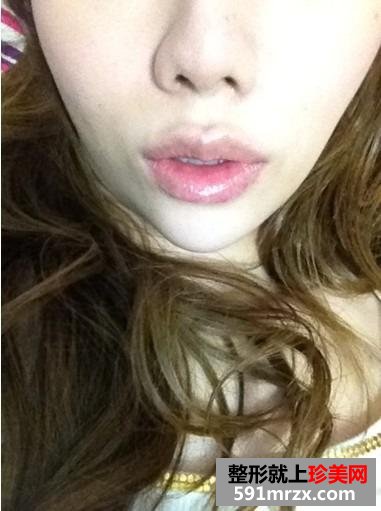 玻尿酸注射丰唇珠手术，让我安吉丽娜朱莉的性感丰唇