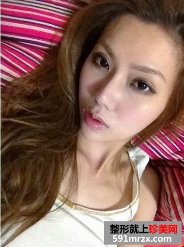 玻尿酸注射丰唇珠手术，让我安吉丽娜朱莉的性感丰唇