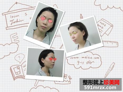 我的自体脂肪面部填充经历，持续更新中~~~