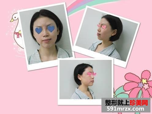 我的自体脂肪面部填充经历，持续更新中~~~