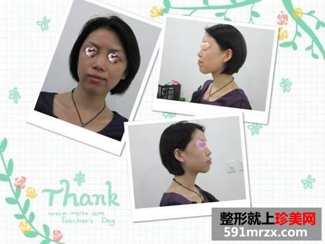 我的自体脂肪面部填充经历，持续更新中~~~