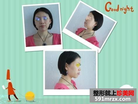 我的自体脂肪面部填充经历，持续更新中~~~