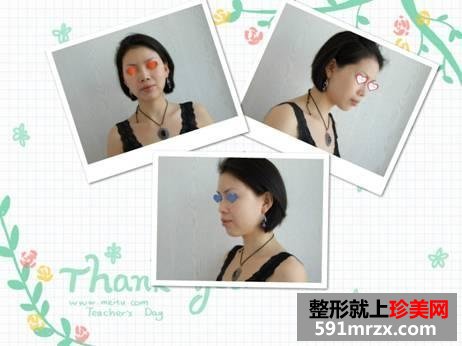 我的自体脂肪面部填充经历，持续更新中~~~