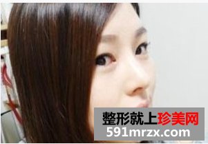 驼峰鼻矫正之后，我感觉生活充满了阳光