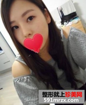 驼峰鼻矫正之后，我感觉生活充满了阳光