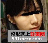 做完假体隆下巴后，好像一下子换了个人