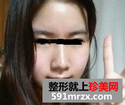 做完假体隆下巴后，好像一下子换了个人