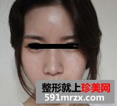 做完假体隆下巴后，好像一下子换了个人