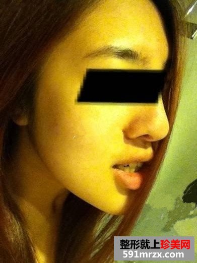去颊脂垫瘦脸，漂亮脸型离你其实并不远