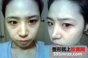 自体脂肪移植丰面颊效果图 自体脂肪面部填充恢复照片