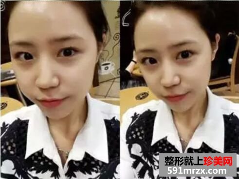 自体脂肪移植丰面颊效果图 自体脂肪面部填充恢复照片