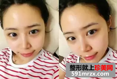 自体脂肪移植丰面颊效果图 自体脂肪面部填充恢复照片