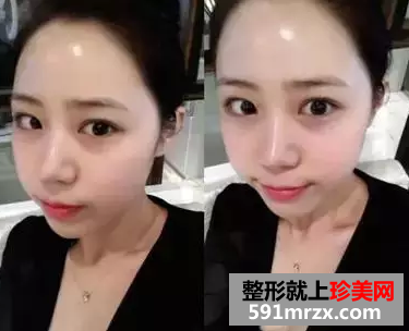 自体脂肪移植丰面颊效果图 自体脂肪面部填充恢复照片