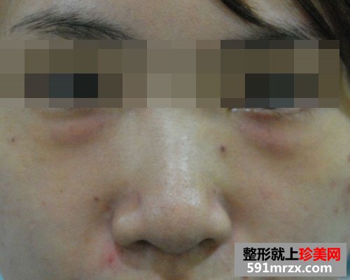 眼袋去除后，眼睛变得炯炯有神了