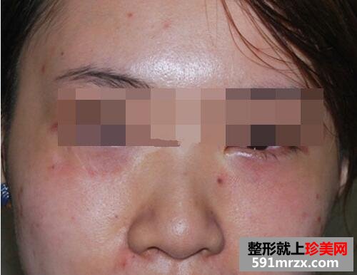 眼袋去除后，眼睛变得炯炯有神了
