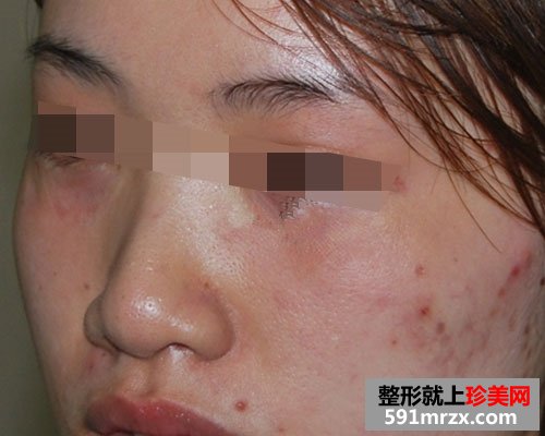 眼袋去除后，眼睛变得炯炯有神了