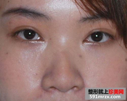 眼袋去除后，眼睛变得炯炯有神了